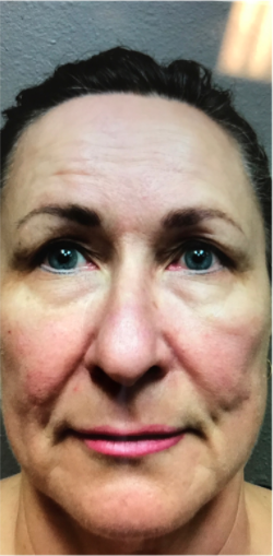 vampire facelift everything you want