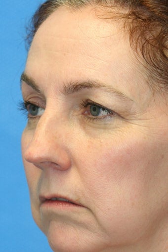 Browlift w hairline lowering, Upper eye blepharoplasty, Lower eyelid ...