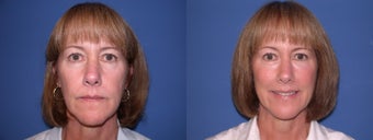 before and after image