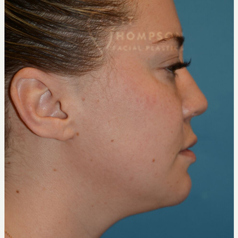 Septoplasty Before & After Pictures - RealSelf