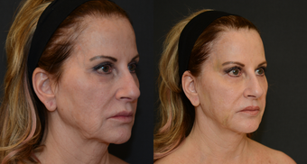 before and after image