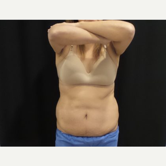 Real Results of Coolsculpting (Before/After Photos) - NOVA Plastic