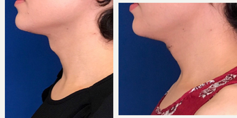 before and after image