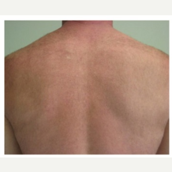 removal hair laser before realself