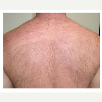 removal hair laser before treated realself