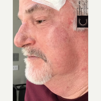 mohs surgery after before cheek realself op months micrographic