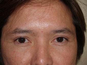Photographs of a 44‐year‐old woman who underwent eyebrow thread