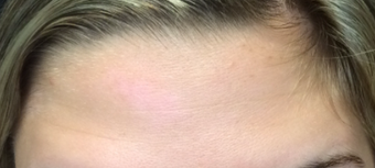 Botox Before & After Pictures - RealSelf