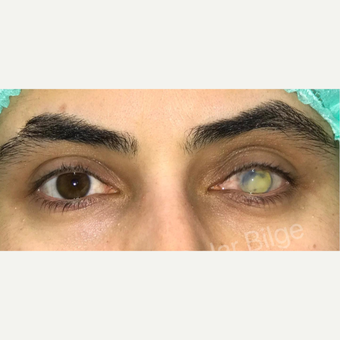 Prosthetic Eye Patient Photos