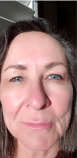 vampire facelift everything you want