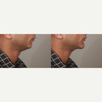 Chin Surgery Before & After Pictures - RealSelf