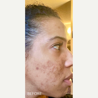 Chemical Peel Before & After