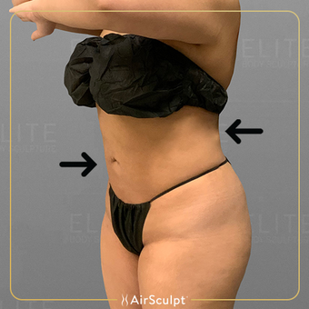AirSculpt® Brazilian Butt Lift Details & Before and Afters