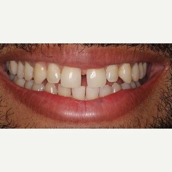 Dental Bonding Before & After Pictures - RealSelf