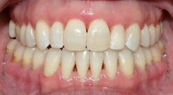 Adult Orthodontic treatment after 223627