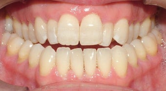 Adult Orthodontic treatment before 223627