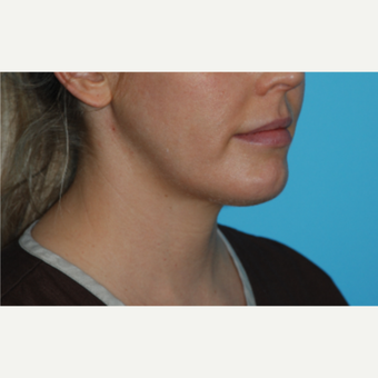 Kybella Before & After Pictures - RealSelf