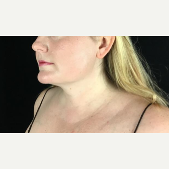 FaceTite Before & After Pictures - RealSelf