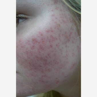 Rosacea Treatment Before & After Pictures - RealSelf