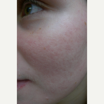 Rosacea Treatment Before & After Pictures - RealSelf