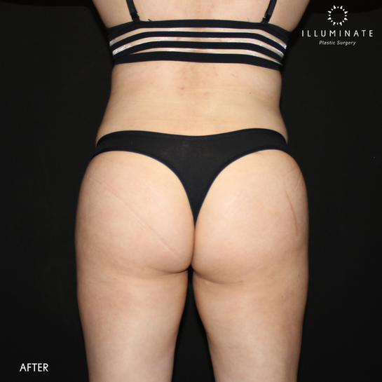 Buttocks Augmentation San Jose, Palo Alto & Carmel, CA