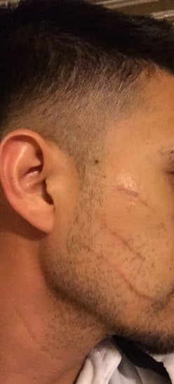 scratch marks on face