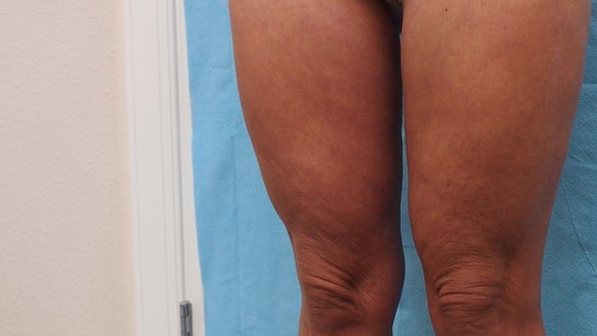 Didn't wear compression garment after thigh liposuction. Now I
