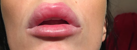 Numbness And Hardness 3 Days After Juvederm Filler In Lips Photo