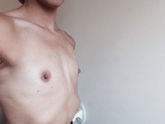 Is there anything I can do about my underdeveloped breasts? (Photo)