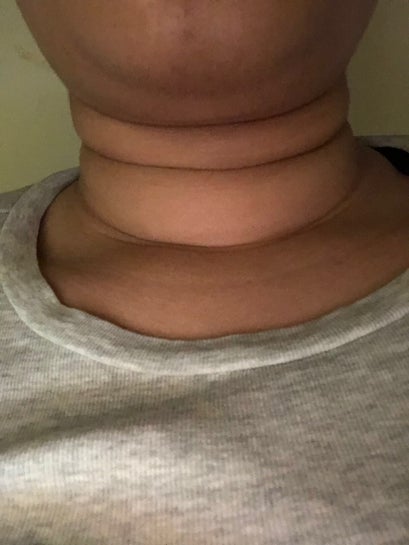 I m 27 years old and I have neck rolls. Should I get a neck lift or liposuction photos