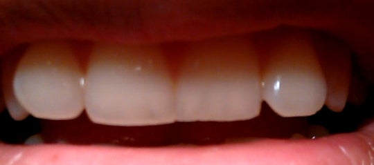 Why are my teeth translucent/transparent? Is there a way to fix? (Photo) Why are my teeth translucent/transparent? Is there a way to fix? (Photo)