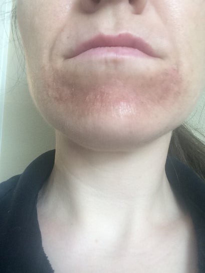 chemical peel for hyperpigmentation