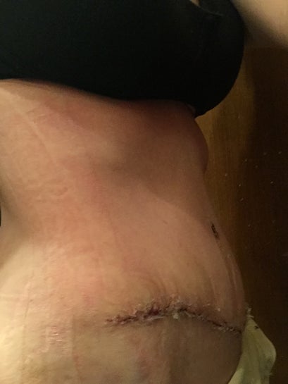 Torn Internal Stitches, Tummy Tuck Risks