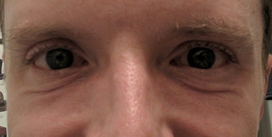 dynamic wrinkles under eyes