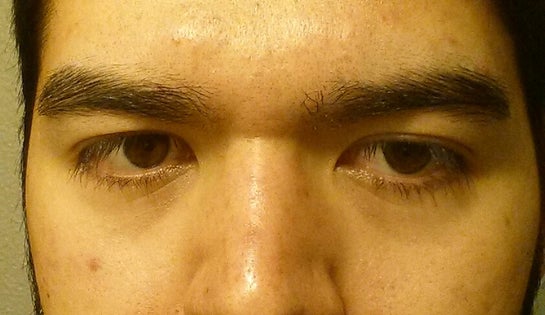 horizontal line between eyebrows