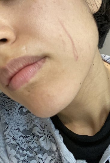 scratch marks on face