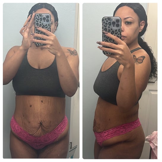 Harmony Lymphatics LLC - This patient is 2 months post-op from a tummy tuck.  The lower abdominal swelling was not going away. The skin is also hardening  and becoming fibrotic. After the