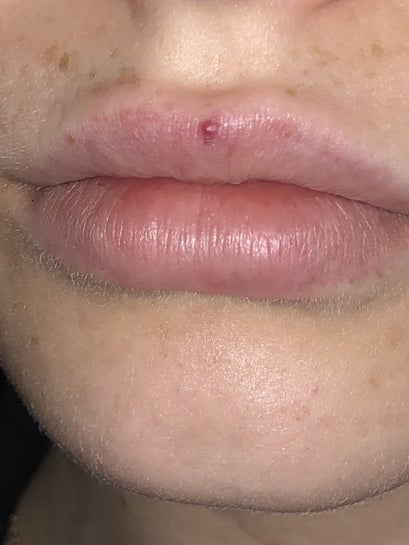 Tiny Red Dot On Lip Line - Infoupdate.org