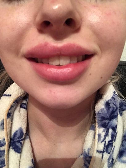 Lip Filler Swelling Stages: What Is Normal