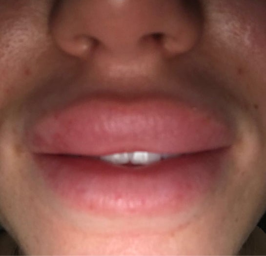 Can I Use Vaseline After Lip Filler? 