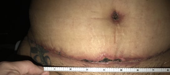 Tummy Tuck Abdominoplasty Scars