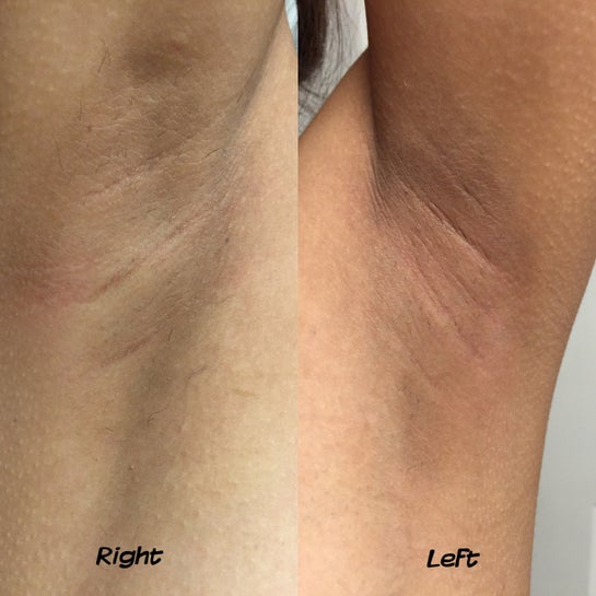 can glutathione whiten dark underarms Know Your GlowWhitening Roll On, Your glow routine doesnt stop at your face., This whitening roll-on helps freshen and brighten while supporting a smoother, more even Effective Solutions for Dark Underarms: