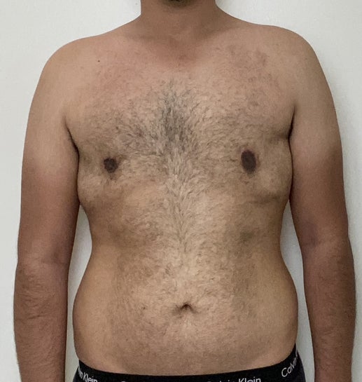 When Should You Consider Tummy Tuck Revision Surgery? Learn How to Improve  Your Results Today!, by Dr. Zoran Potparic