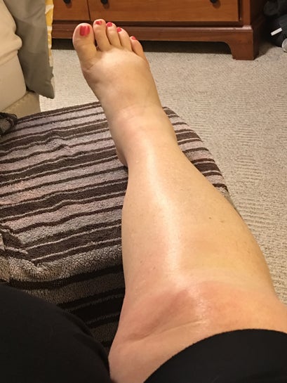 Should My Hips Legs And Feet Be Swollen On Day 10 Post Tummy Tuck And Lipo Of Back And Flanks Photos