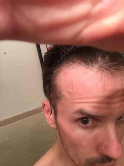 Can I get hair restoration only on my temples? If so, how many grafts would  I need based on the pics? (photos)