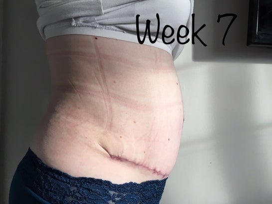 Is it OK to continue swelling each week after 9 weeks post op tummy tuck?  Was completely flat week 4 but not now (Photo)