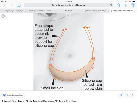 How Does the GalaFORM Internal Bra Support Breasts?