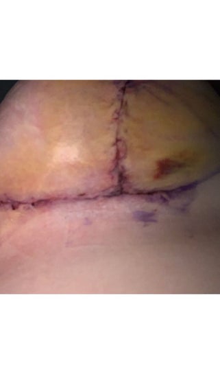 Top 10 Strategies to Reduce Bruising After Breast Uplift Surgery