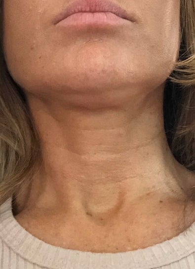 best for crepey neck