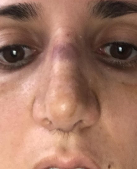 Bruised nose hotsell